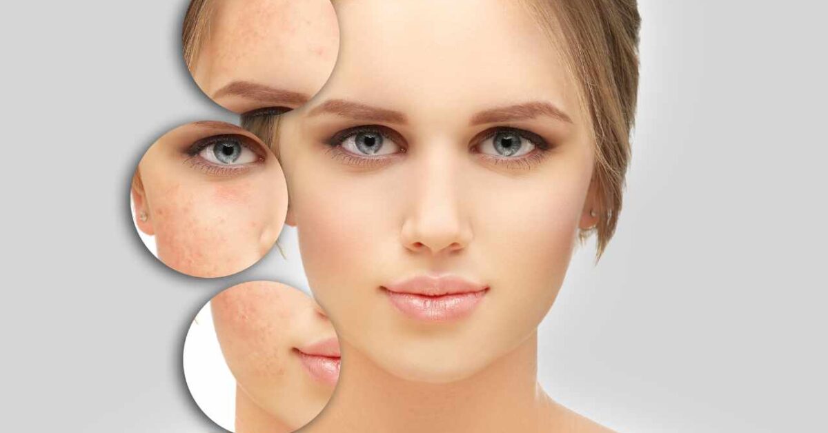 Acne E Cicatrici Prova Questi Rimedi Naturali