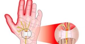 Rimedi per ridurre il dolore del tunnel carpale