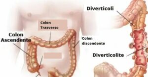 Cosa sono i diverticoli e come trattare la diverticolosi e la diverticolite