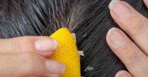 Come combattere la caduta dei capelli con il succo di limone