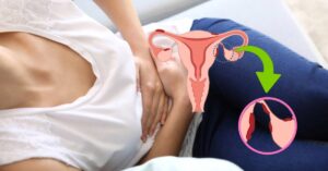 Endometriosi: cos’è, sintomi, modalità di trattamento