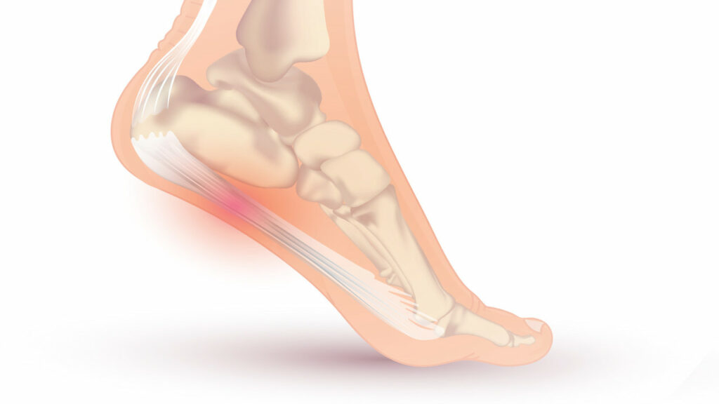Infiammazione tallone piede