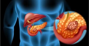 I sintomi più comuni di cancro al pancreas