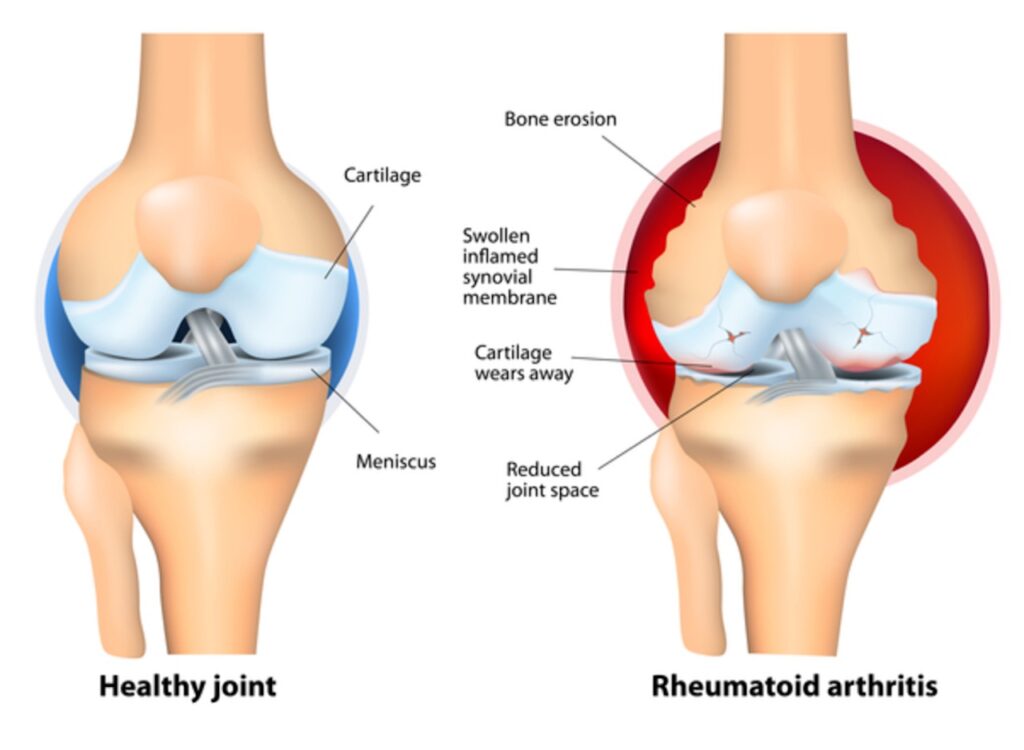 Artrite reumatoide