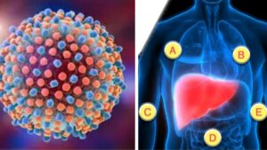 Epatite: tipologie e principali caratteristiche