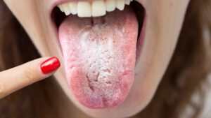 Cosa dice il colore della tua lingua sulla tua salute