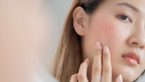 Soffri di rosacea? 5 cose che dovresti evitare